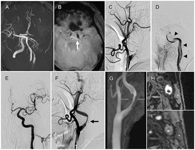 Atherosclerotic Components in Thrombi Retrieved by Thrombectomy for Internal Carotid Artery Occlusion Due to Large Artery Atherosclerosis: A Case Report